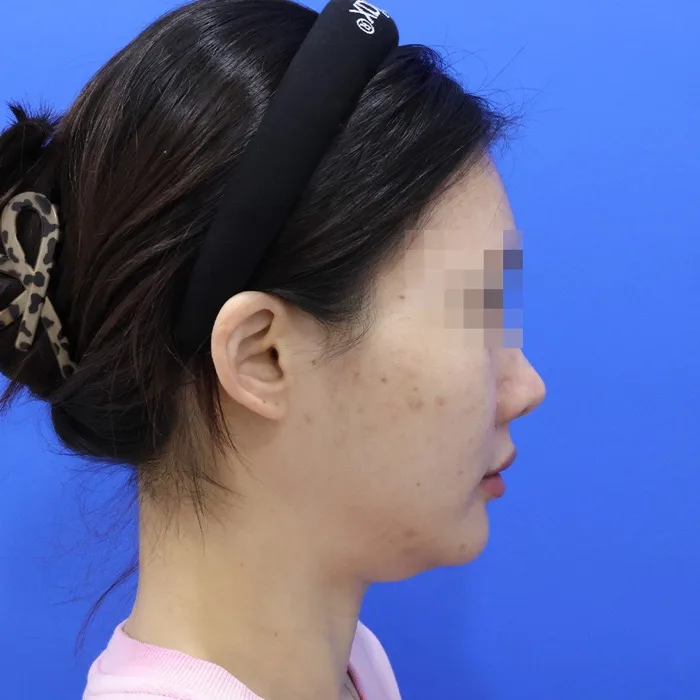 Trước khi điều trị — căng chỉ kèm hút mỡ nọng cằm và xử lý cơ bám da cổ, ảnh nghiêng